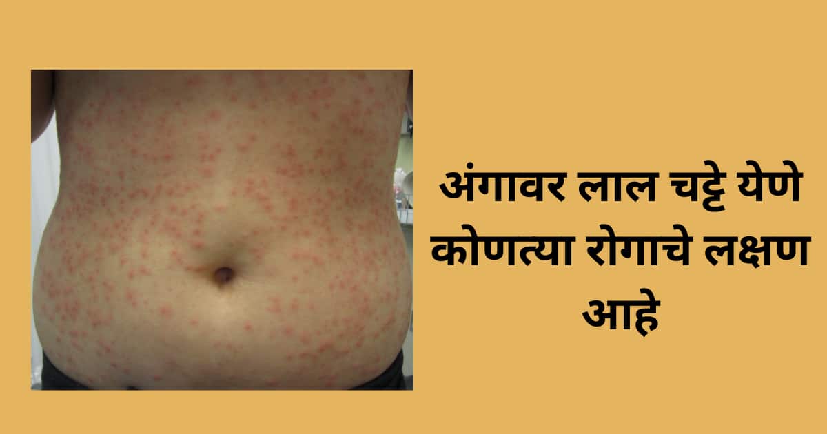 अंगावर लाल चट्टे येणे कोणत्या रोगाचे लक्षण आहे